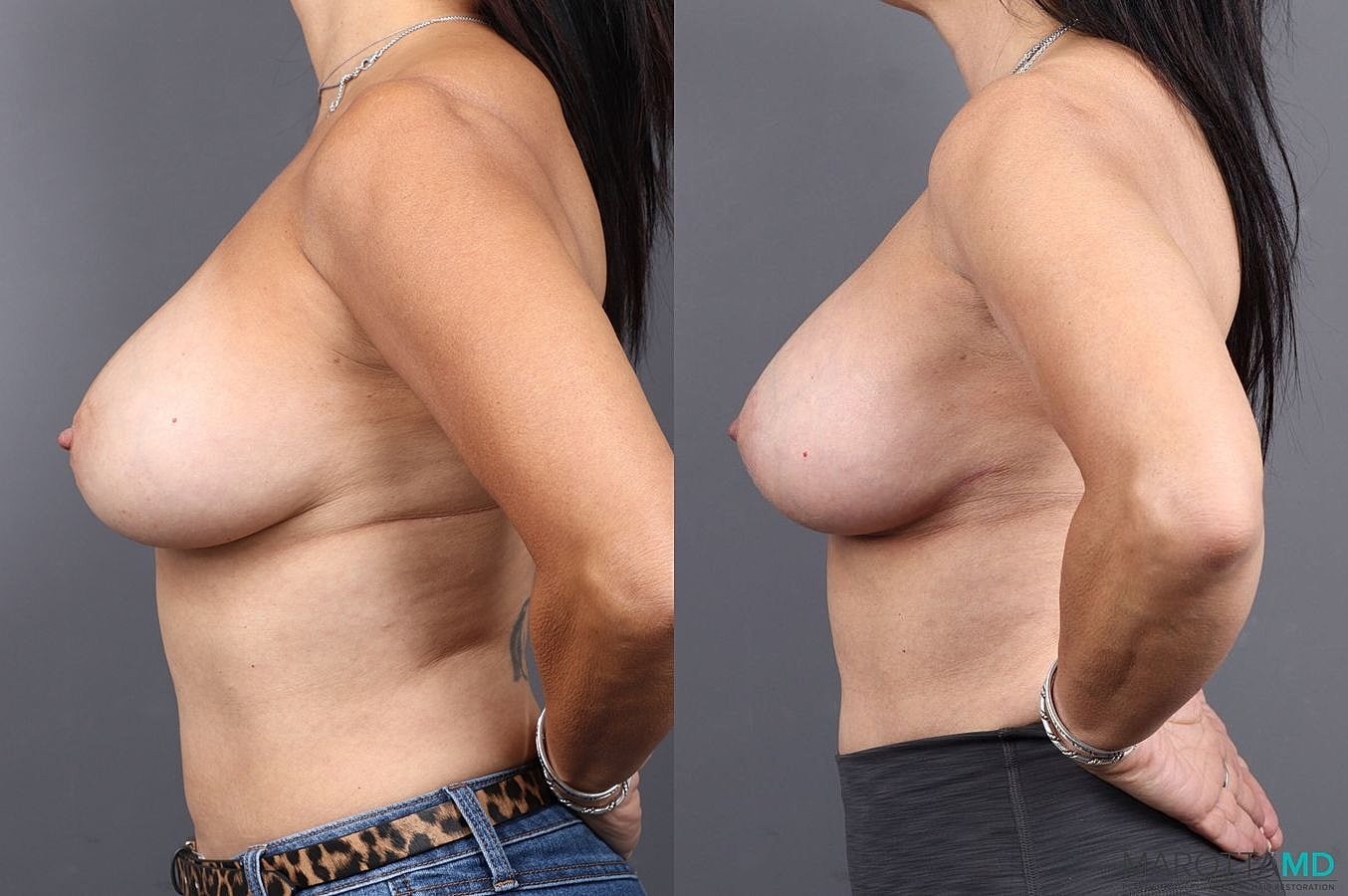 Breast Lift Before & After