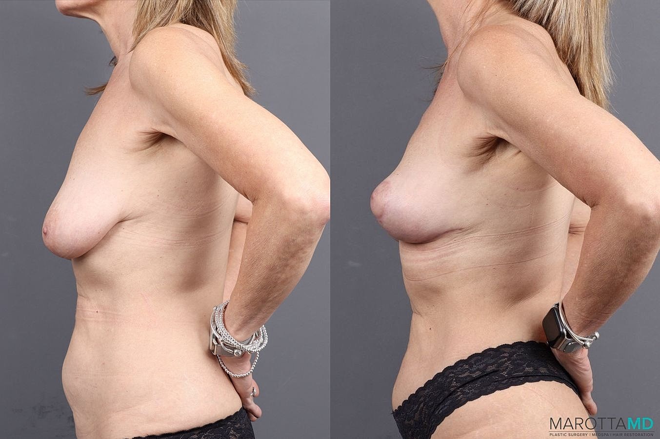 Breast Lift Before & After