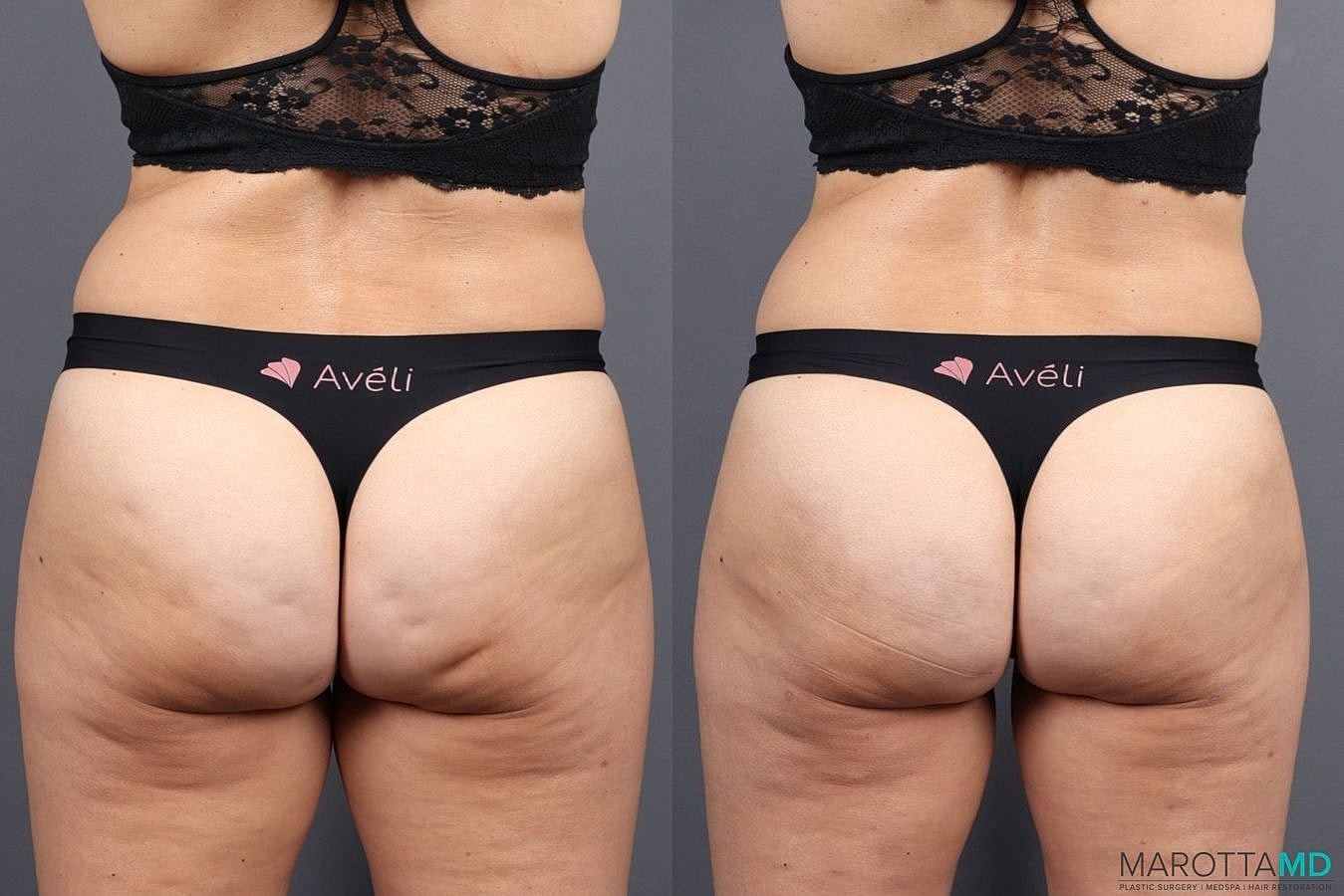 Aveli Before & After