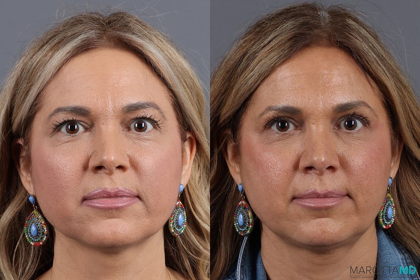 Upper Blepharoplasty Before & After