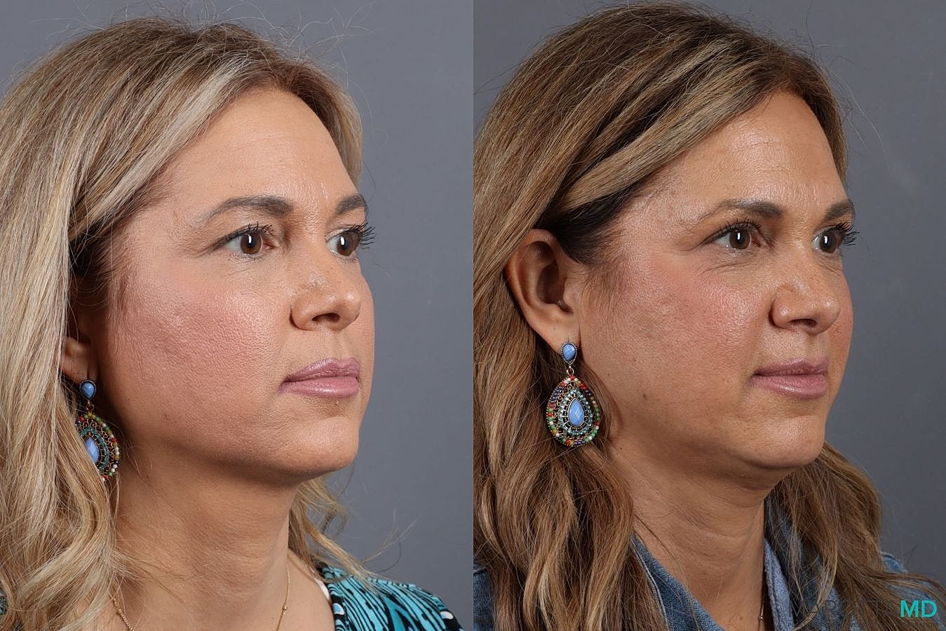 Upper Blepharoplasty Before & After