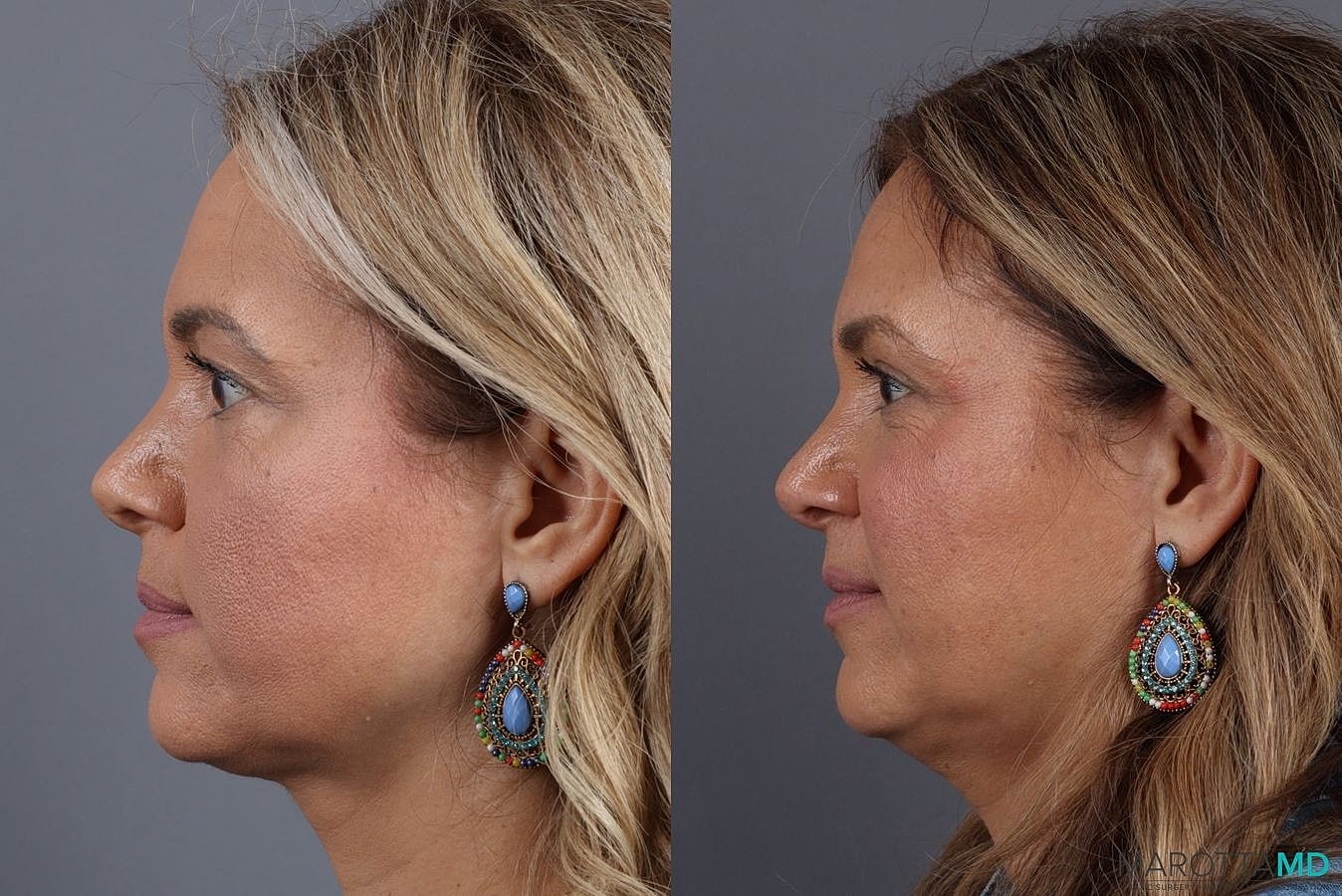 Upper Blepharoplasty Before & After