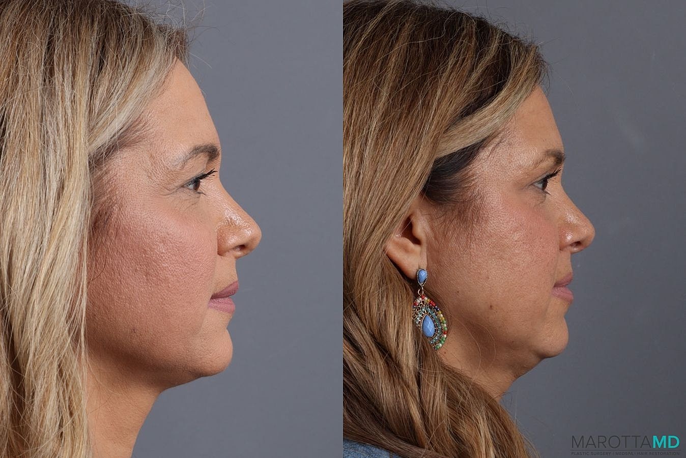 Upper Blepharoplasty Before & After