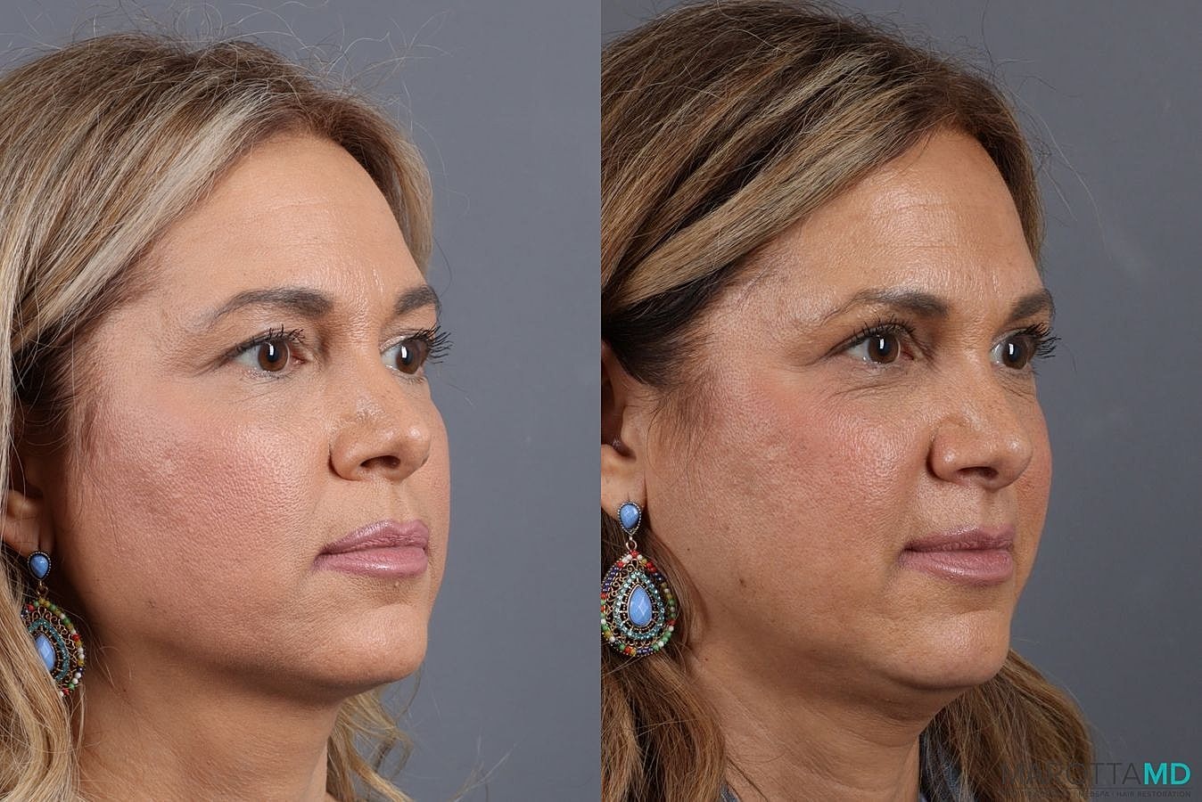Upper Blepharoplasty Before & After