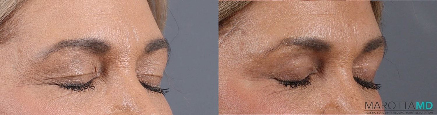 Upper Blepharoplasty Before & After
