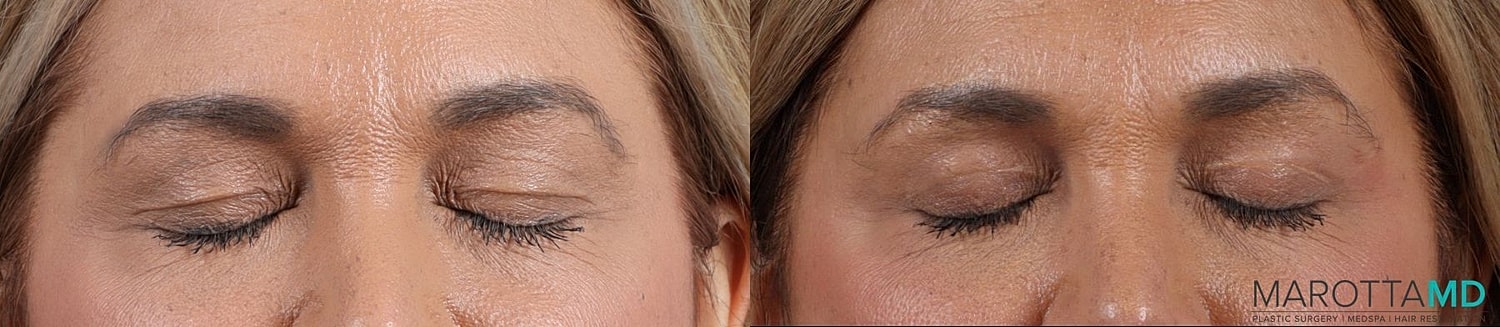 Upper Blepharoplasty Before & After