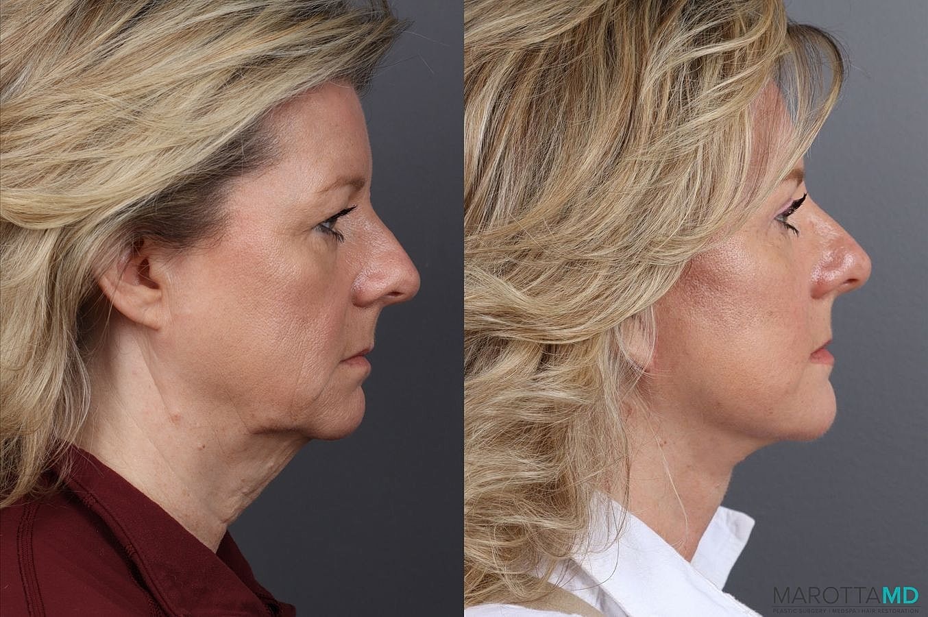 Upper Blepharoplasty Before & After