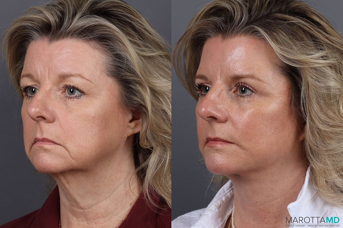 Upper Blepharoplasty Before & After
