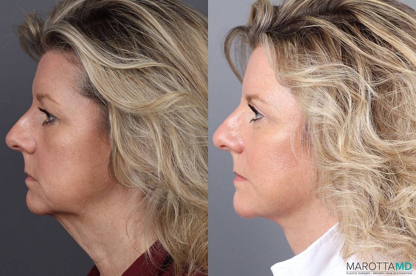 Upper Blepharoplasty Before & After