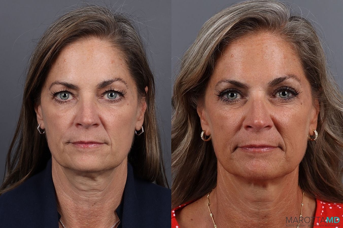 Upper Blepharoplasty Before & After
