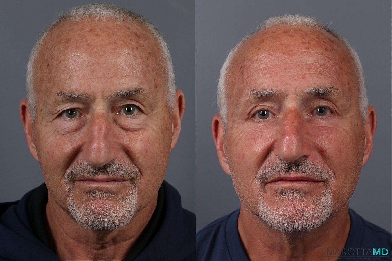 Upper Blepharoplasty Before & After