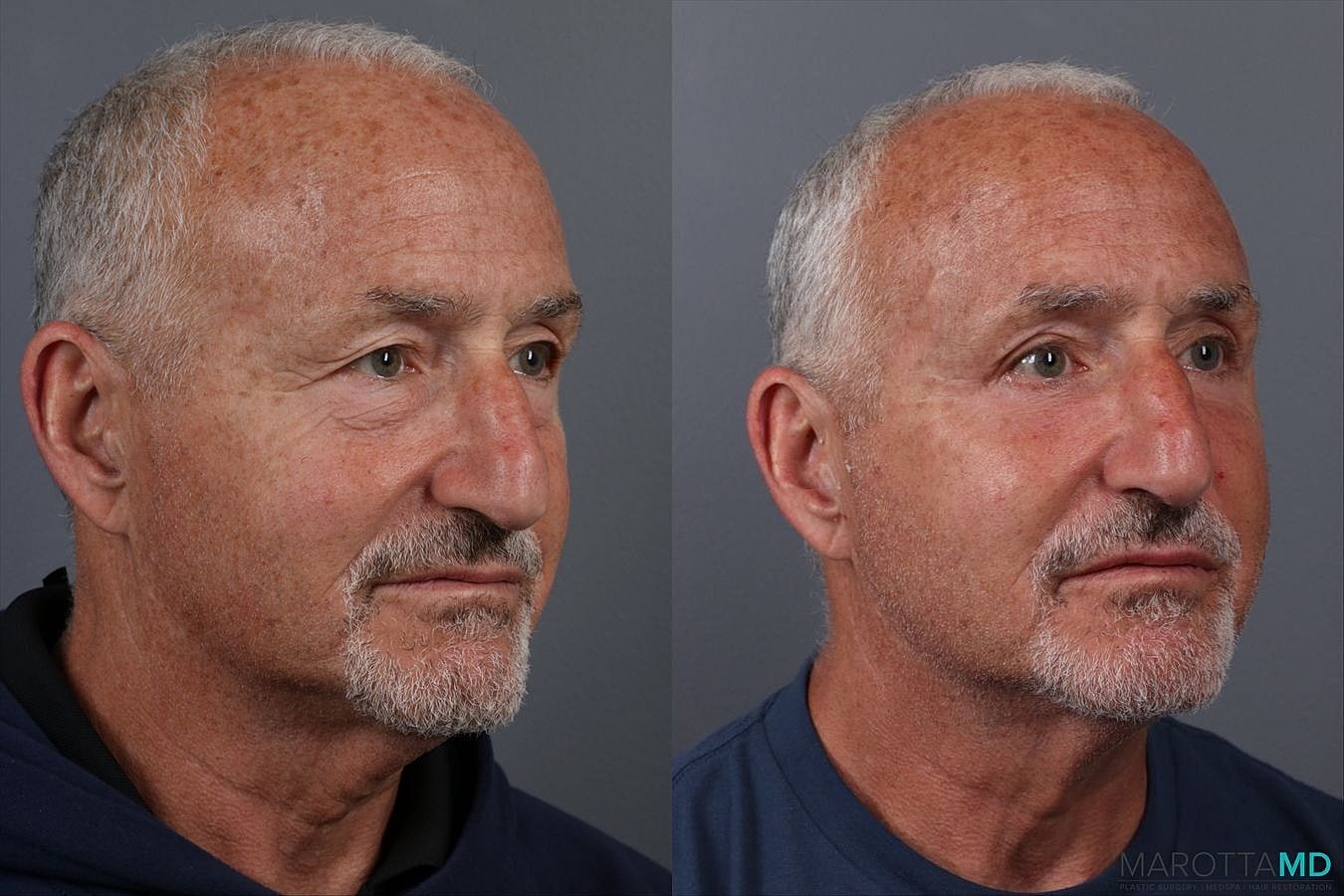Upper Blepharoplasty Before & After