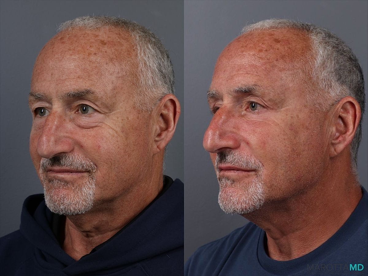 Upper Blepharoplasty Before & After