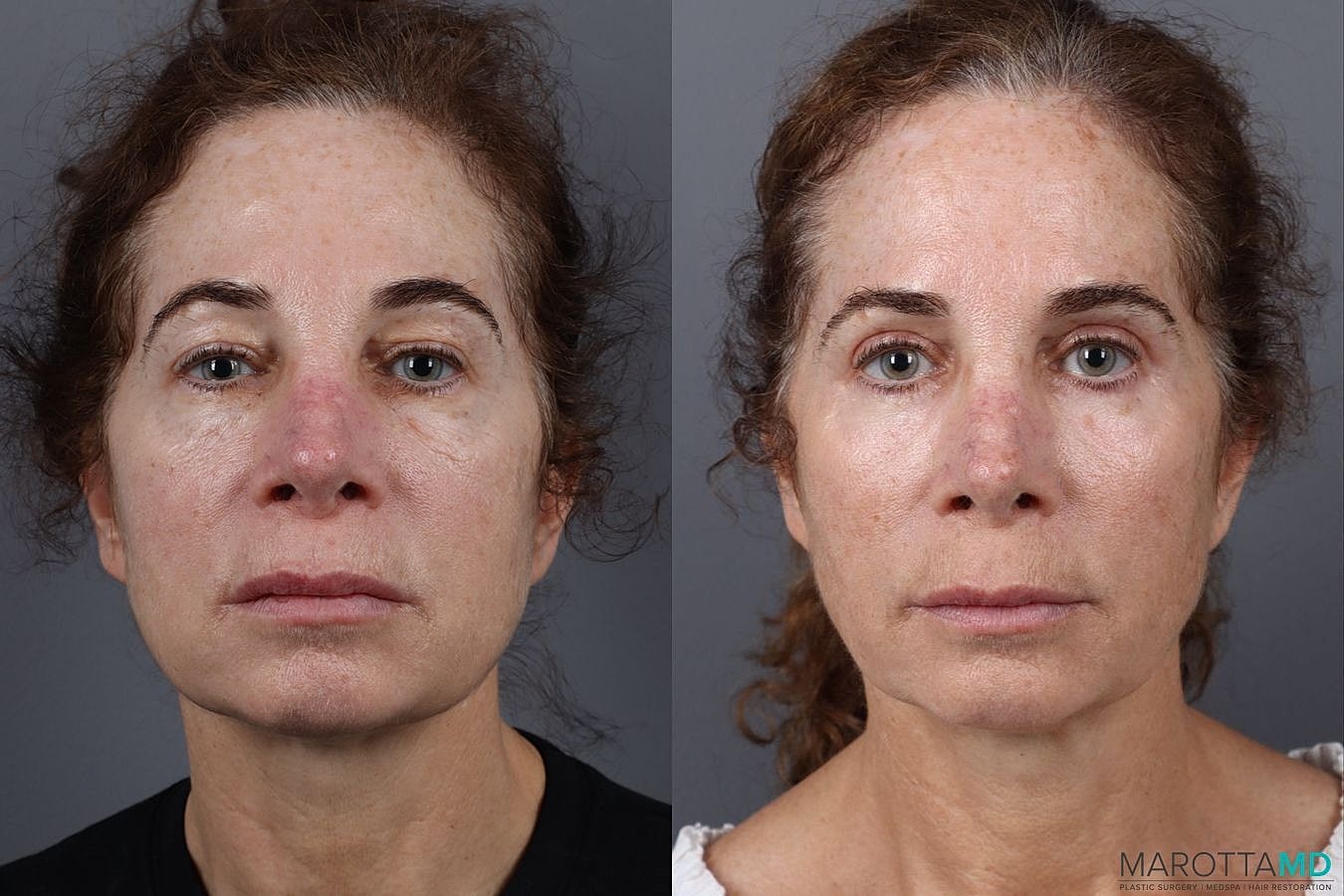 Upper Blepharoplasty Before & After