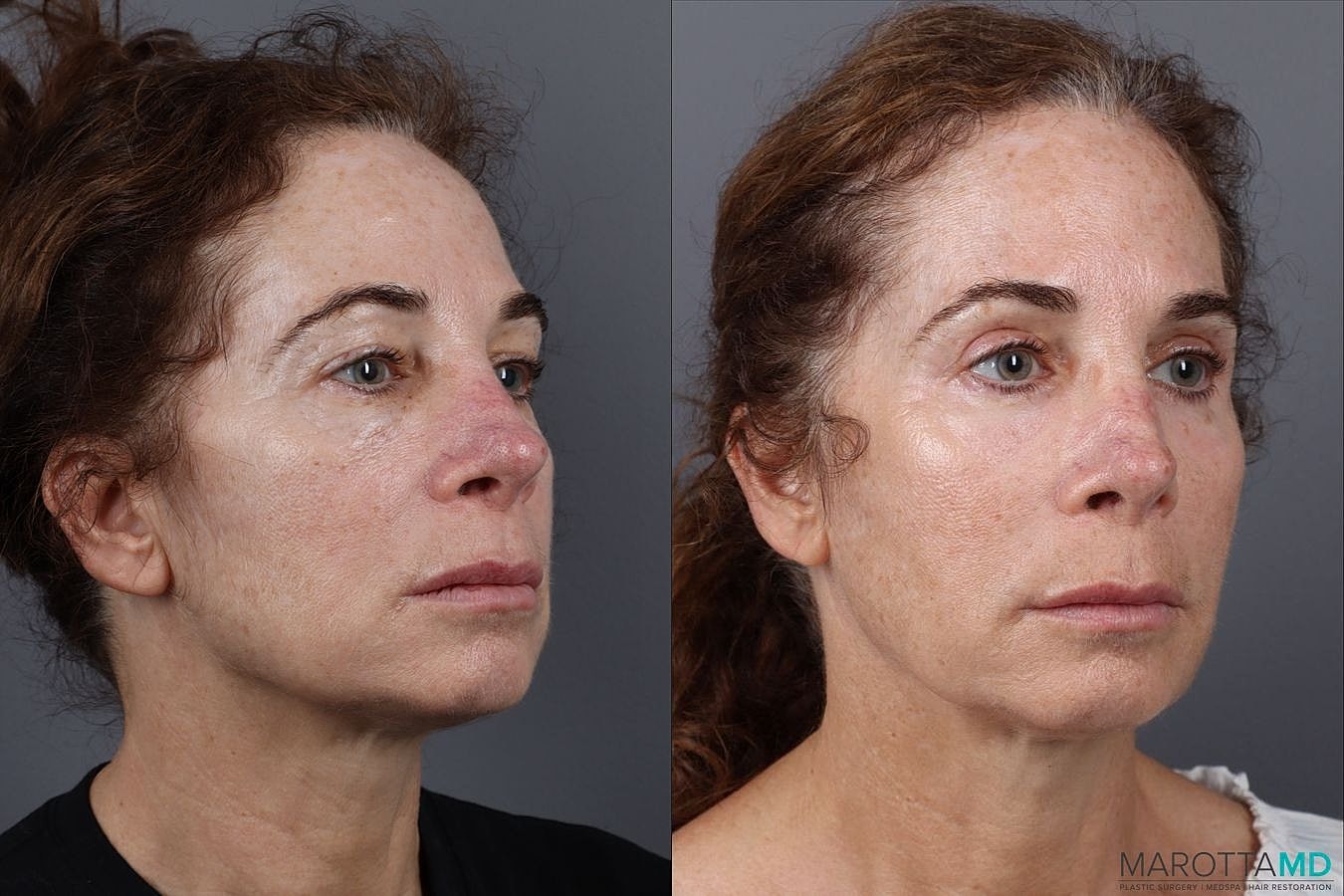 Upper Blepharoplasty Before & After