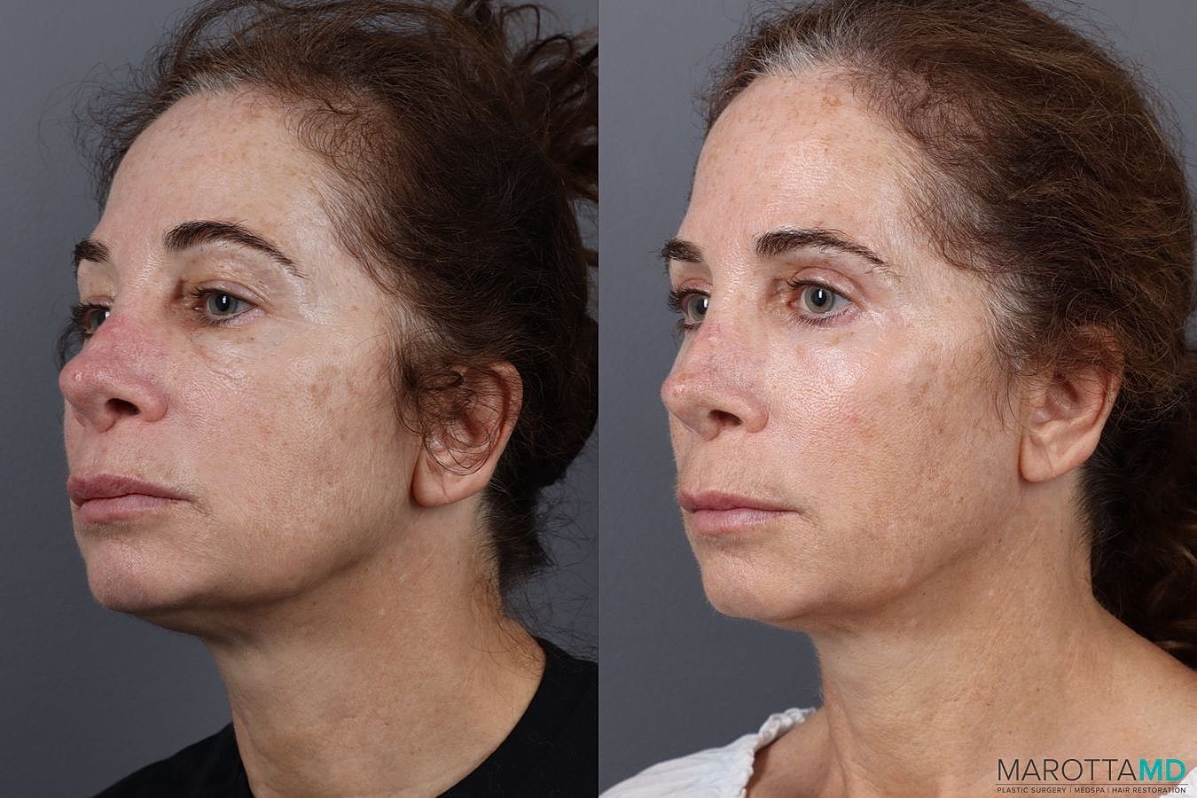 Upper Blepharoplasty Before & After