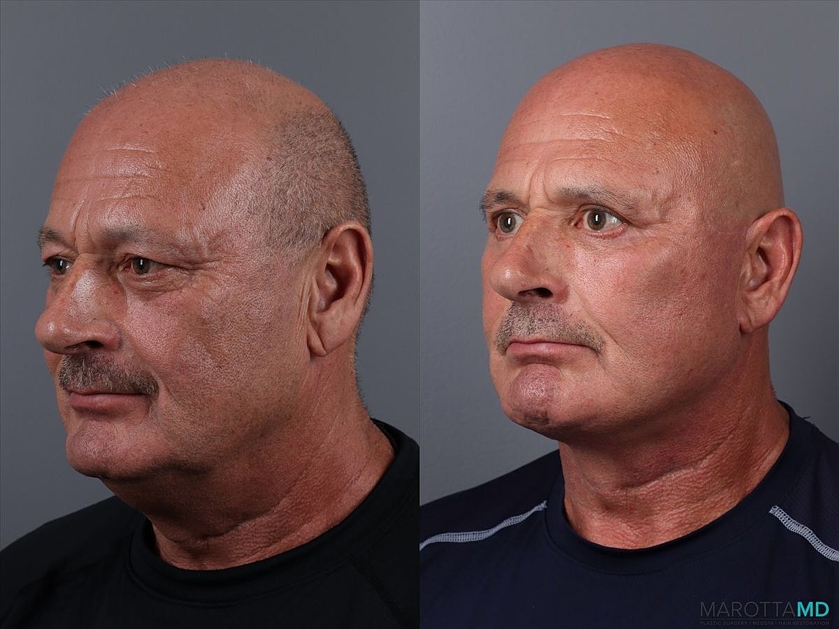 Upper Blepharoplasty Before & After