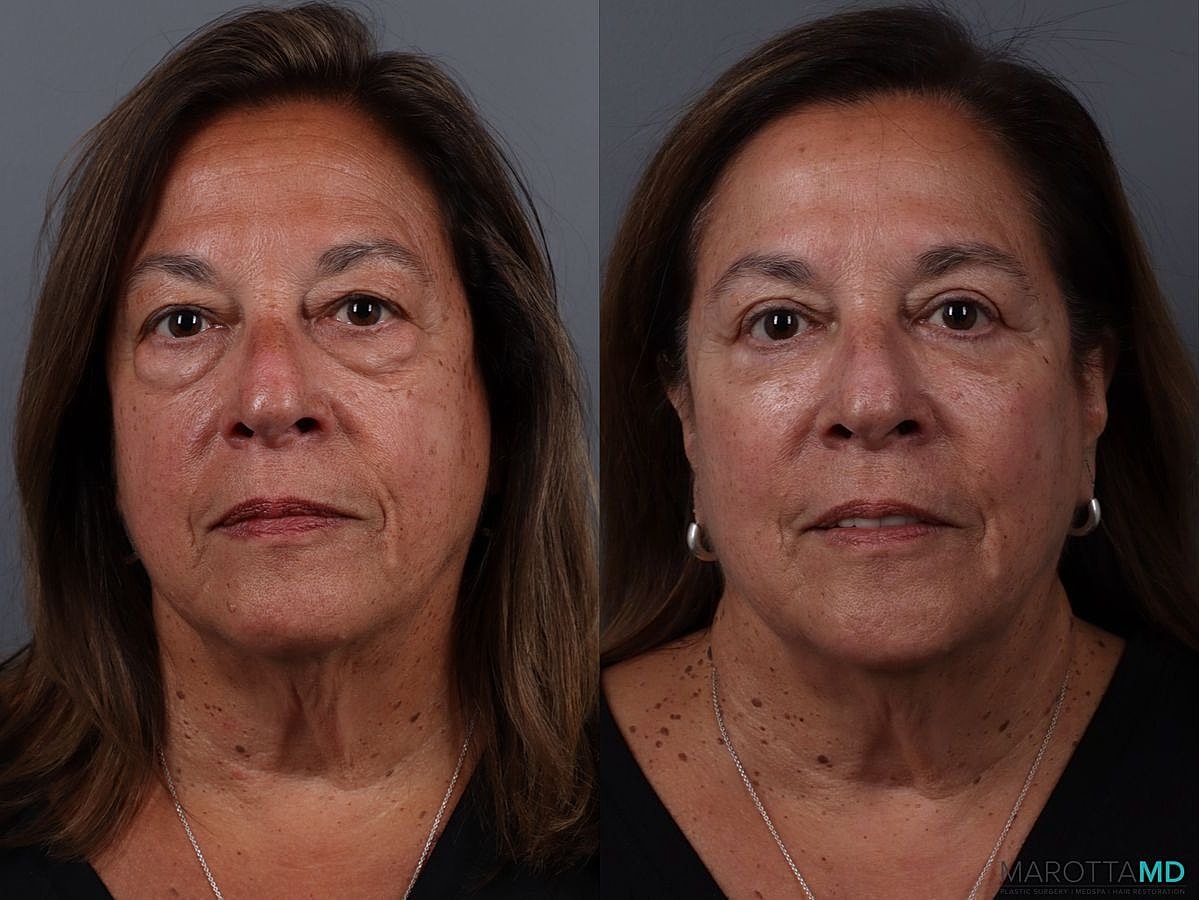 Upper Blepharoplasty Before & After