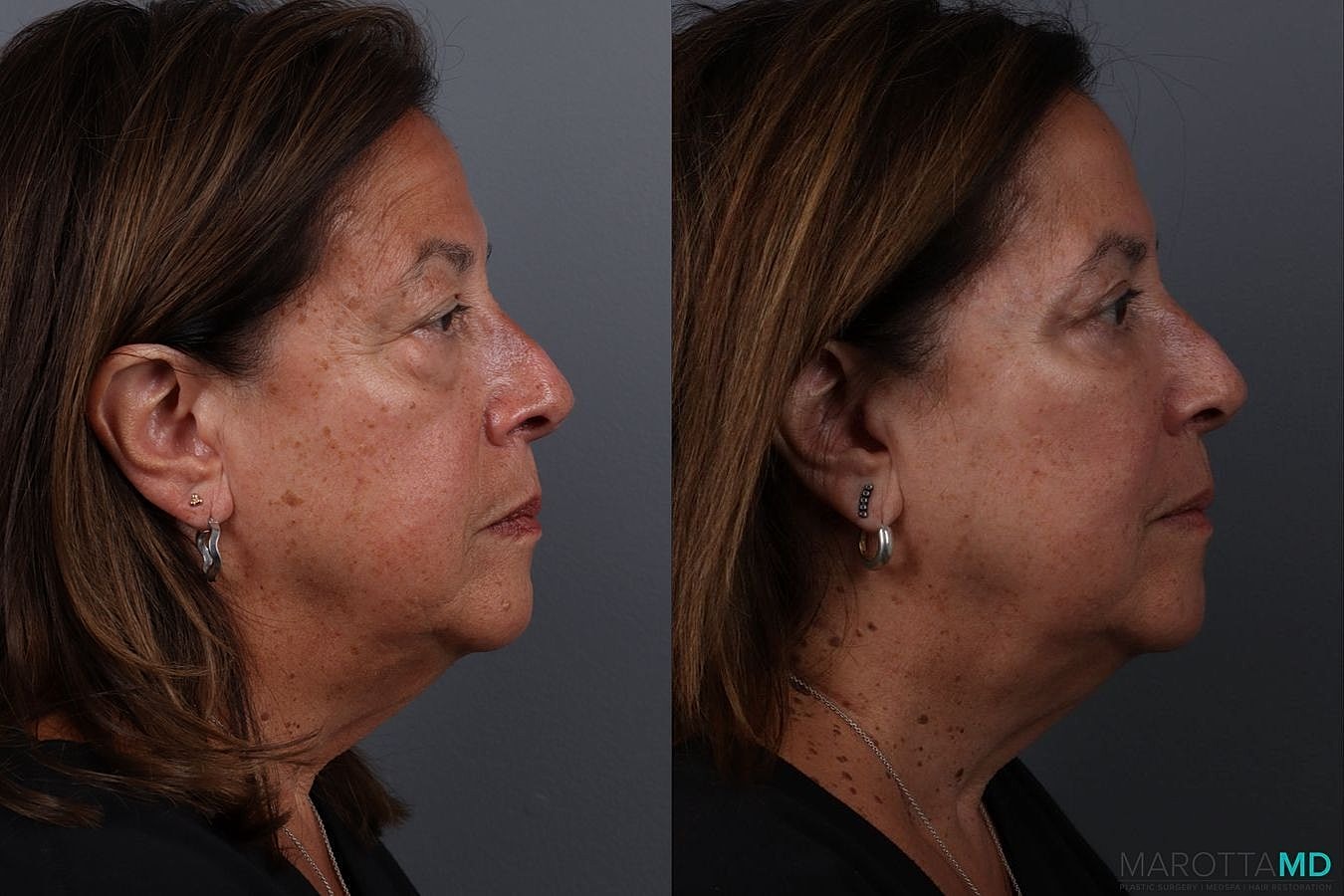Upper Blepharoplasty Before & After