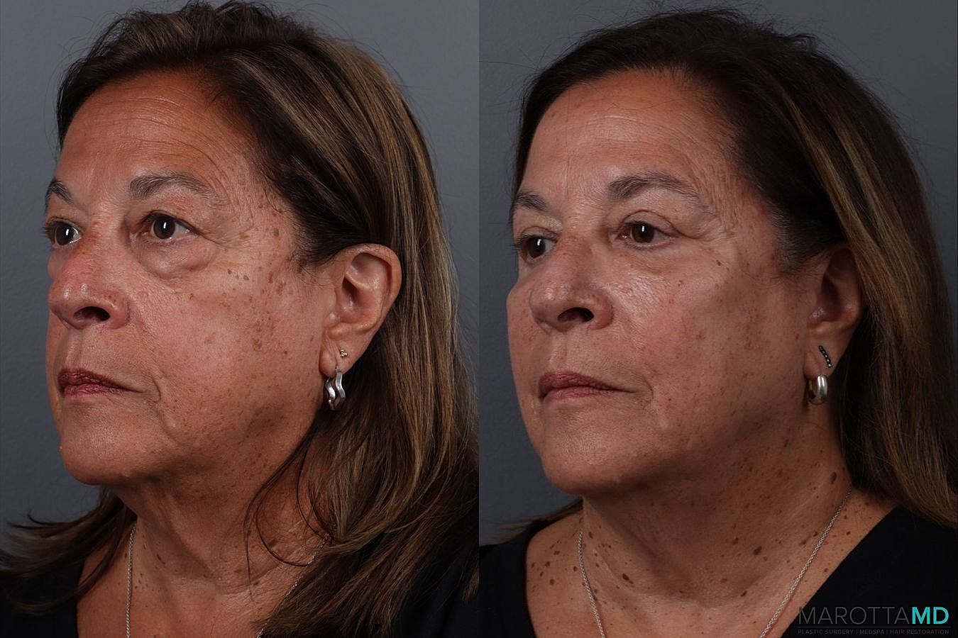 Upper Blepharoplasty Before & After