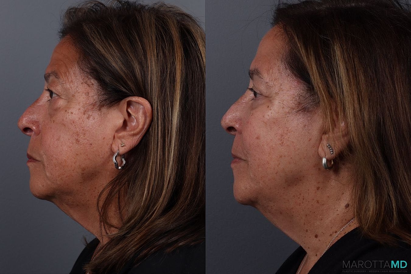 Upper Blepharoplasty Before & After