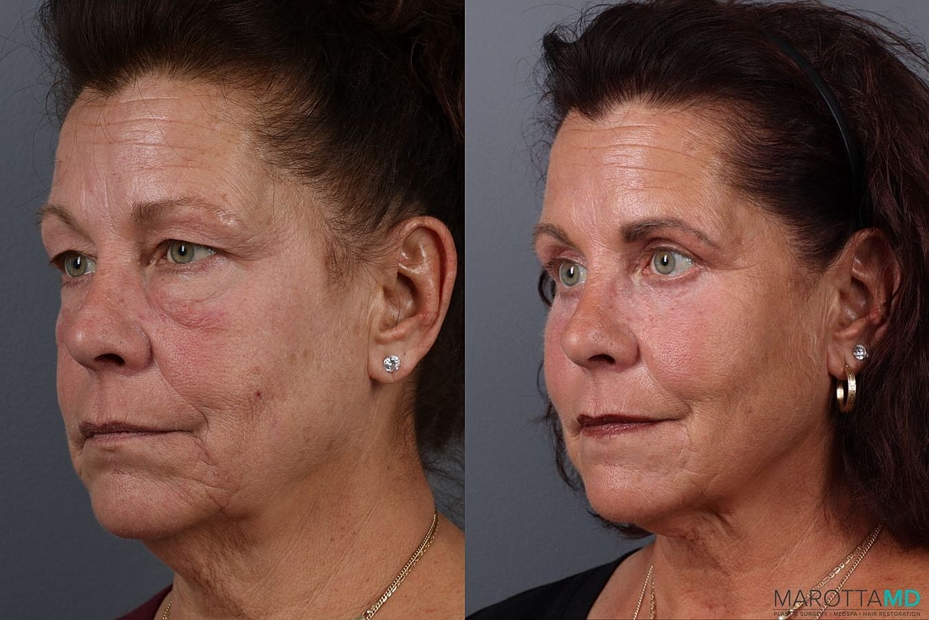 Upper Blepharoplasty Before & After