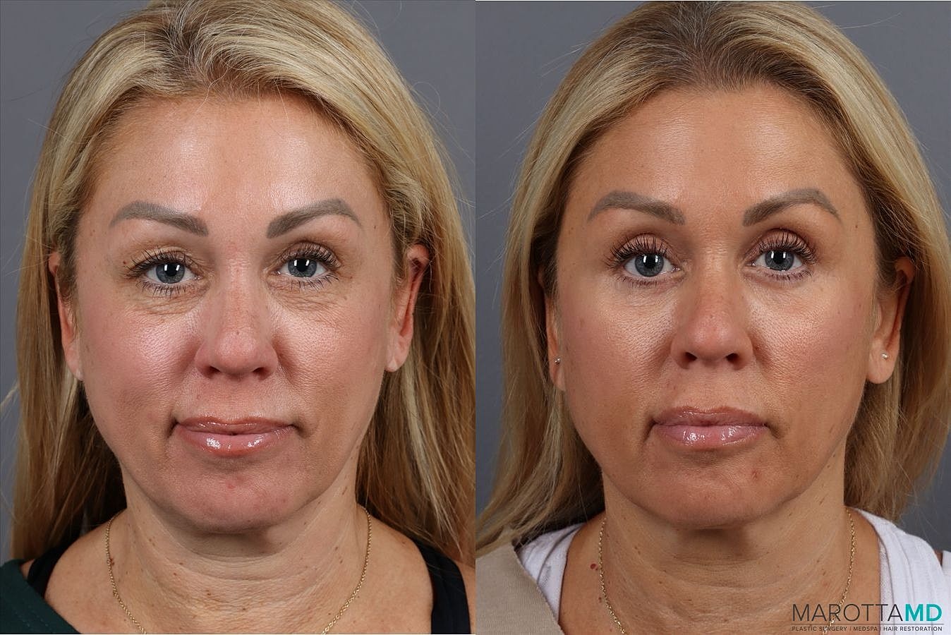 Upper Blepharoplasty Before & After