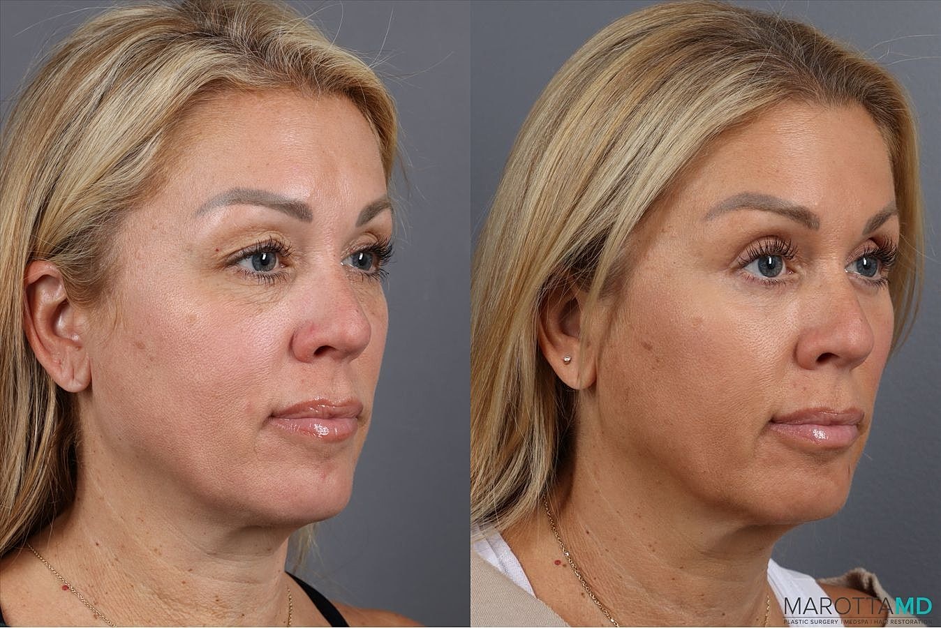 Upper Blepharoplasty Before & After