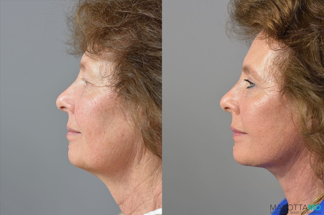 Upper Blepharoplasty Before & After