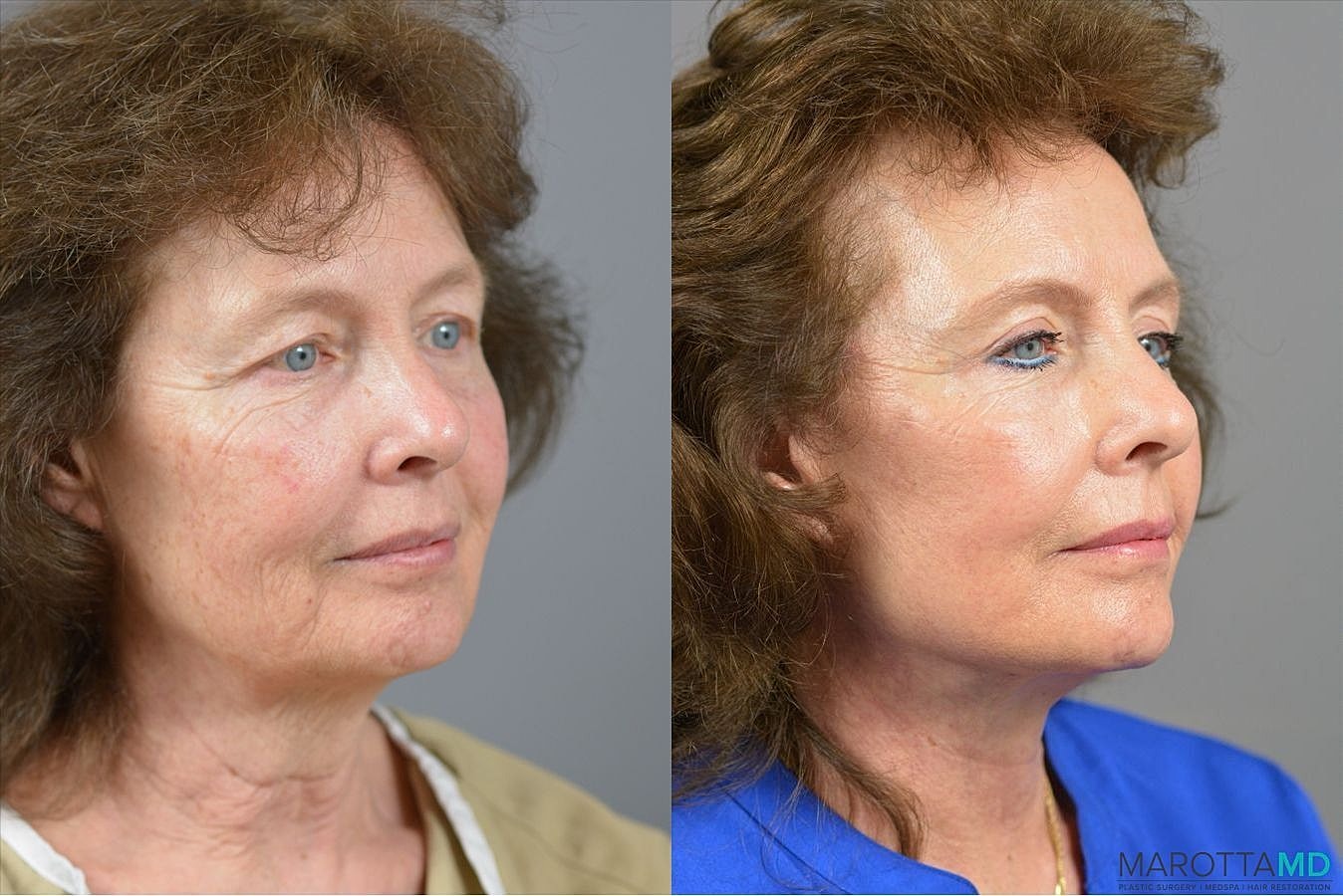 Upper Blepharoplasty Before & After