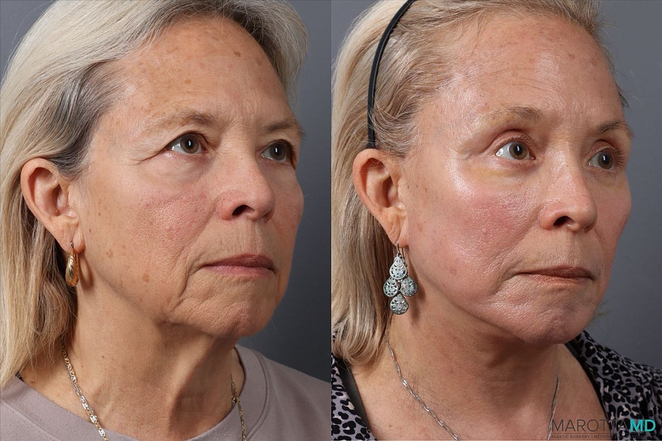 Upper Blepharoplasty Before & After