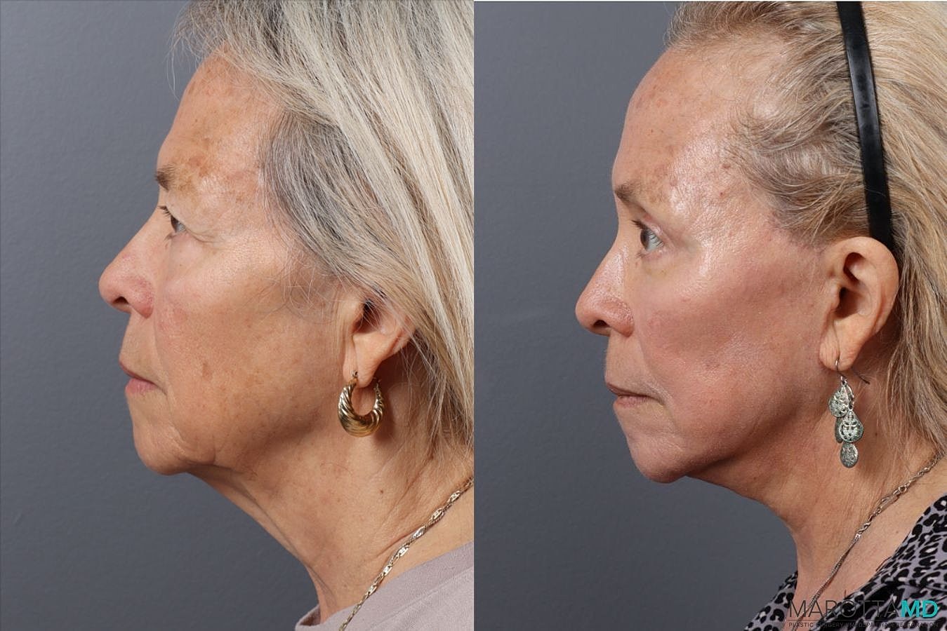 Upper Blepharoplasty Before & After