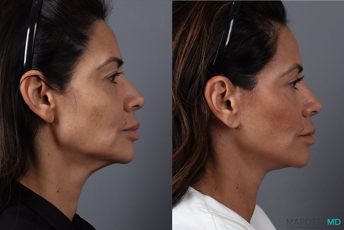 Upper Blepharoplasty Before & After
