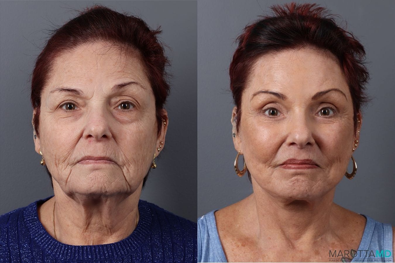 Upper Blepharoplasty Before & After