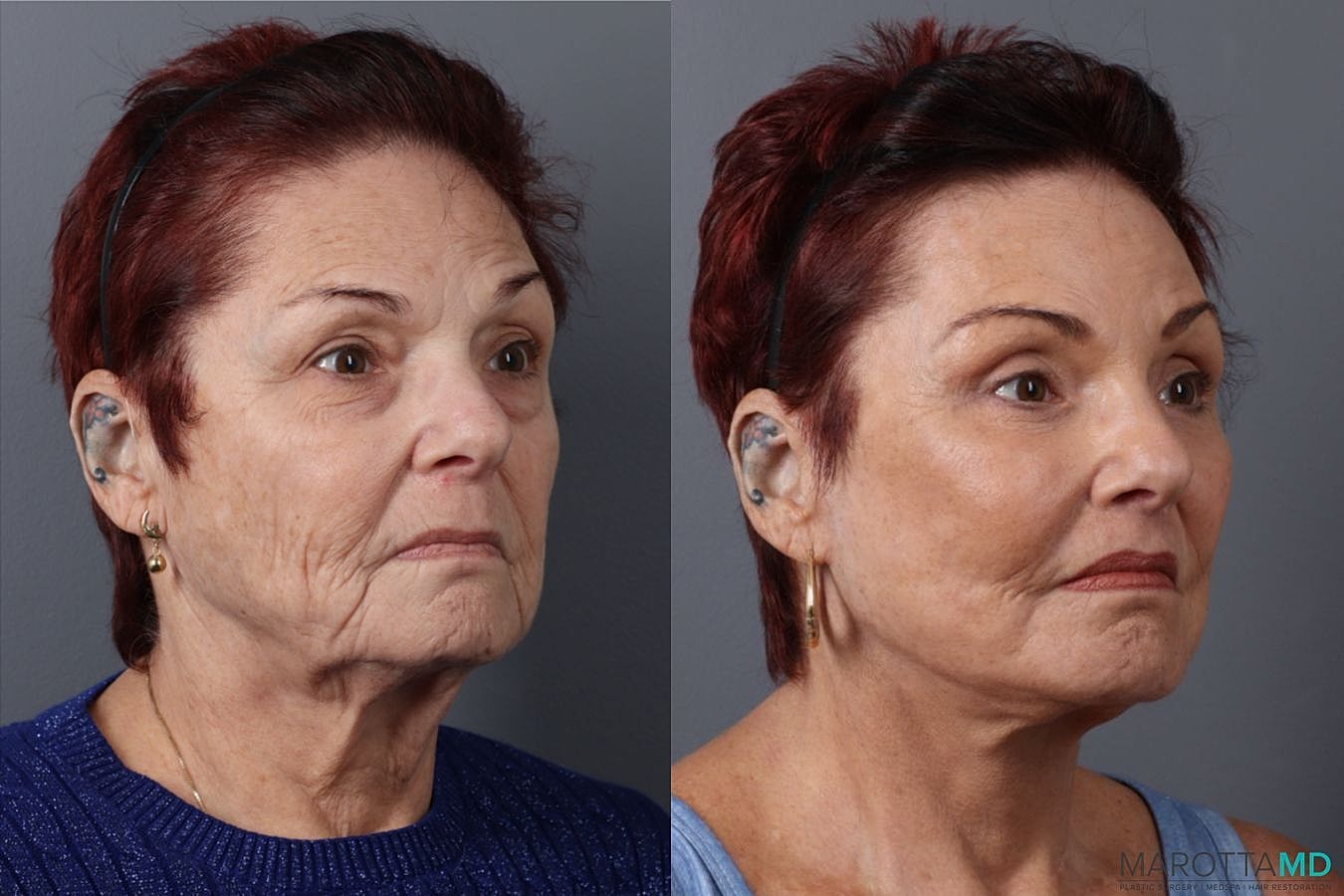 Upper Blepharoplasty Before & After