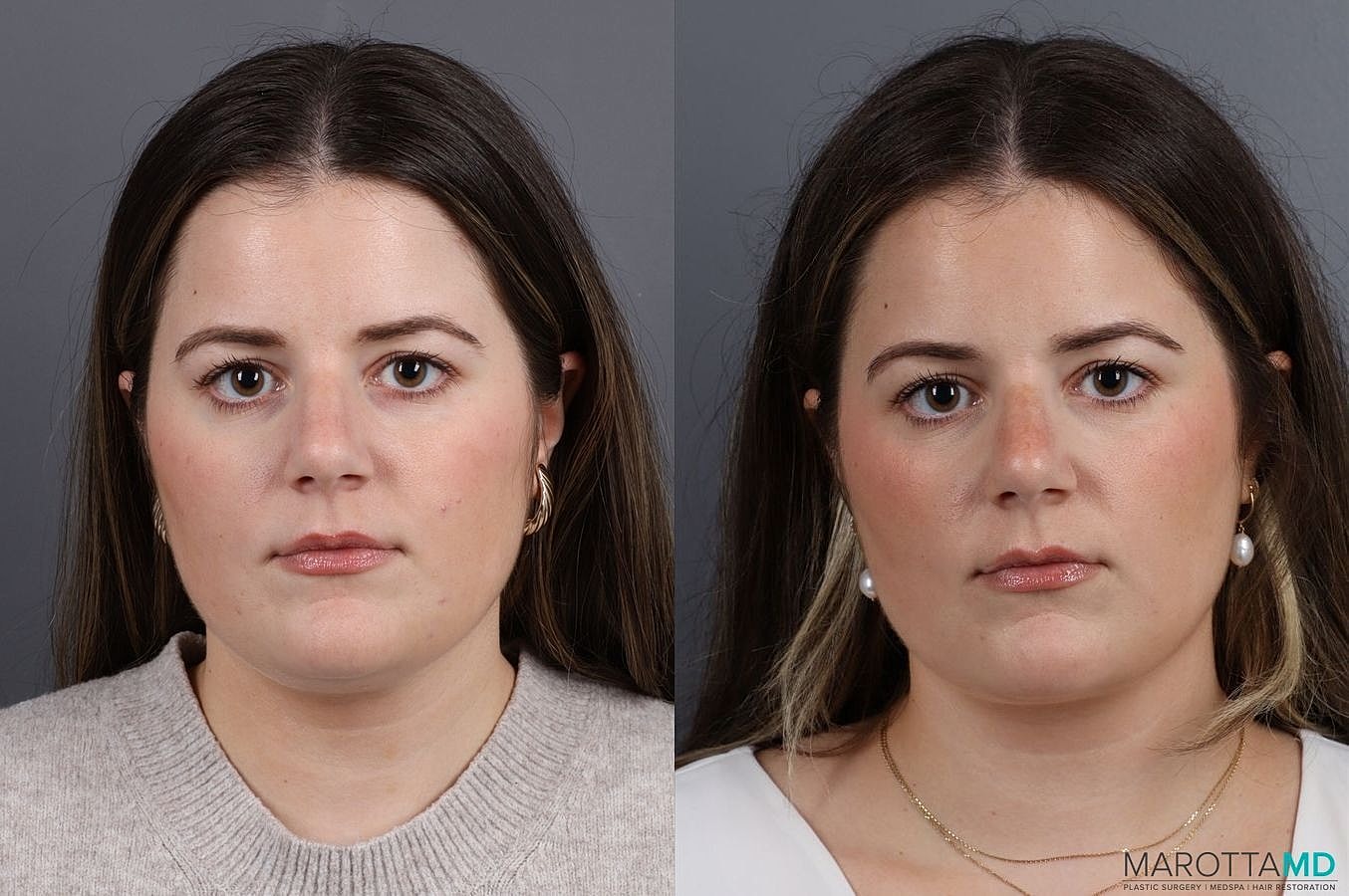 Skin Tightening Before & After