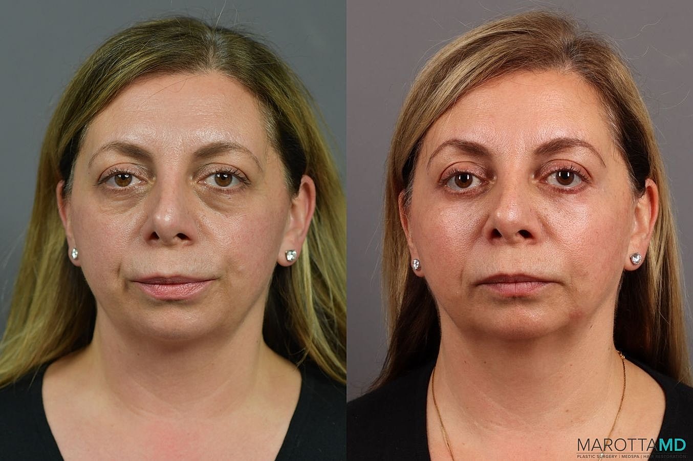 Lower Blepharoplasty Before & After