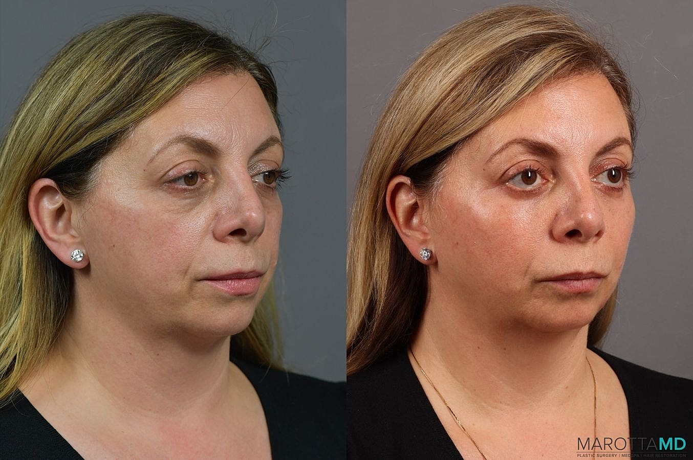 Lower Blepharoplasty Before & After