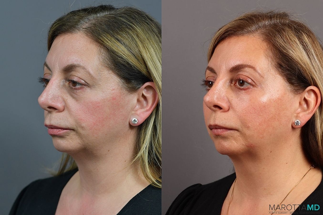 Lower Blepharoplasty Before & After