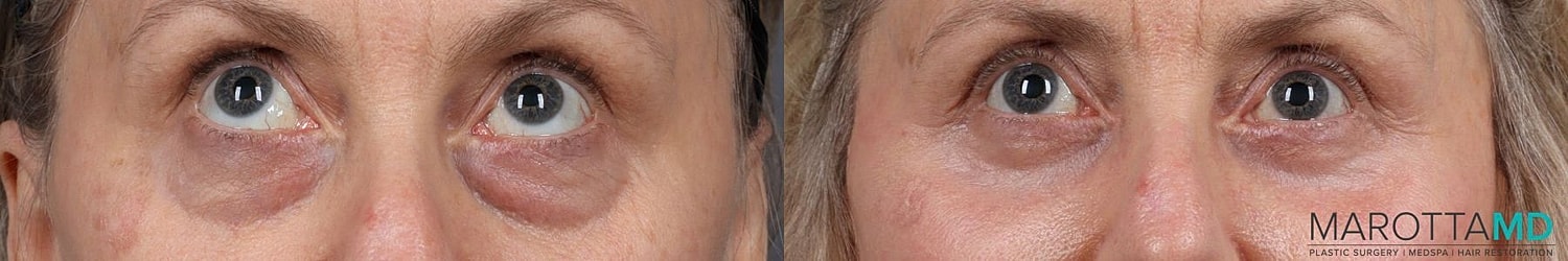 Lower Blepharoplasty Before & After