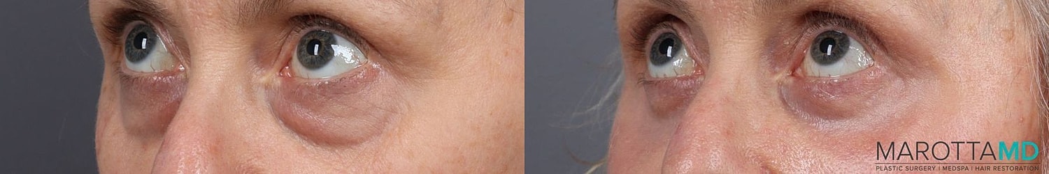 Lower Blepharoplasty Before & After