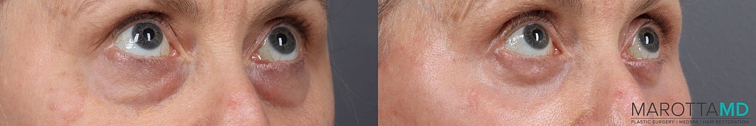 Lower Blepharoplasty Before & After