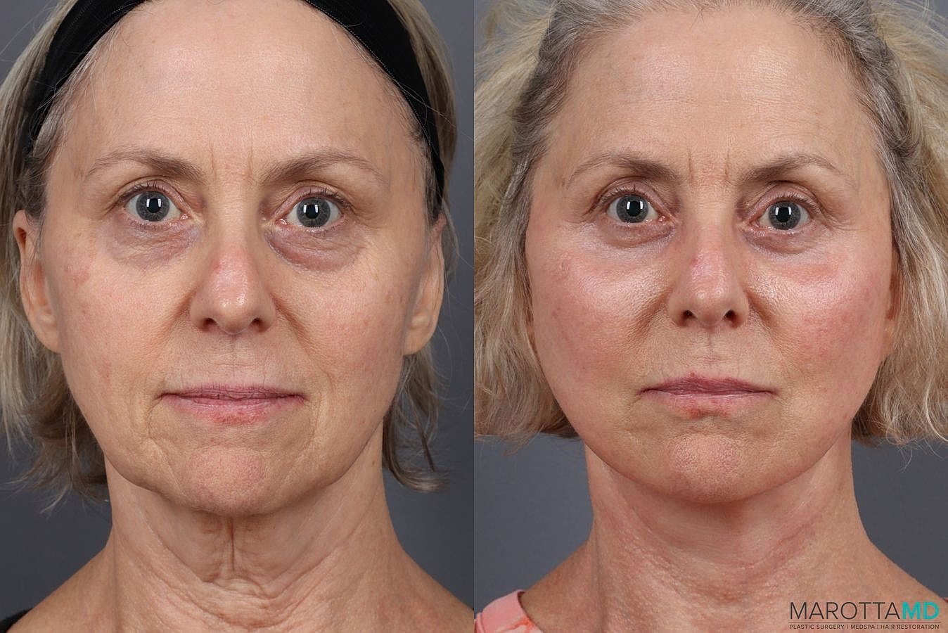 Lower Blepharoplasty Before & After