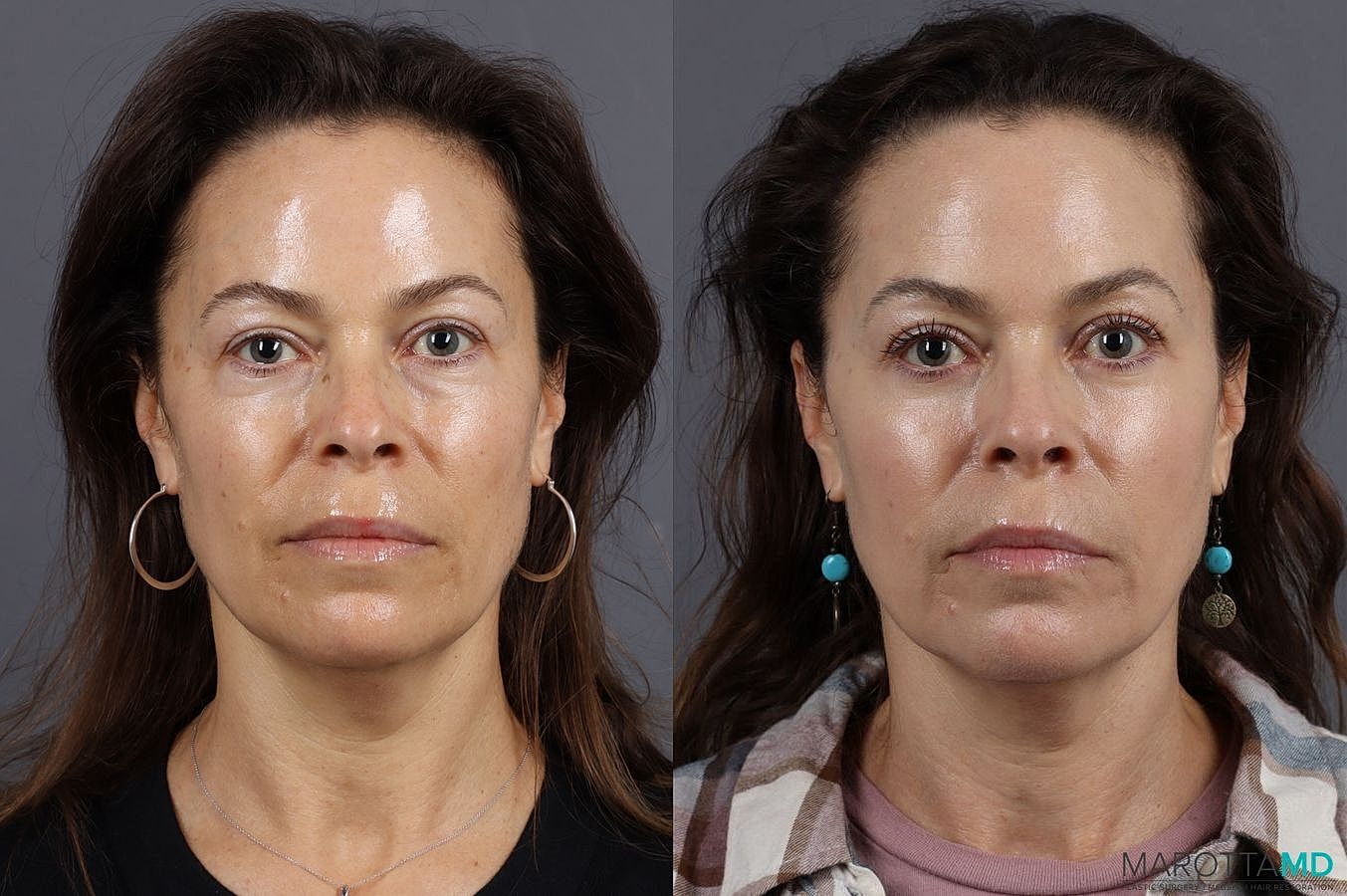 Lower Blepharoplasty Before & After