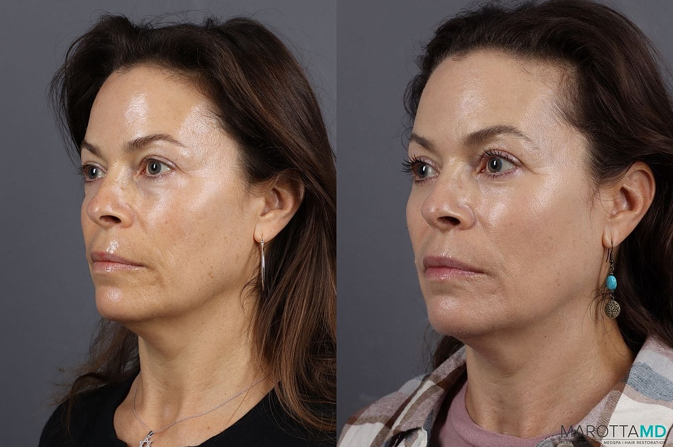 Lower Blepharoplasty Before & After