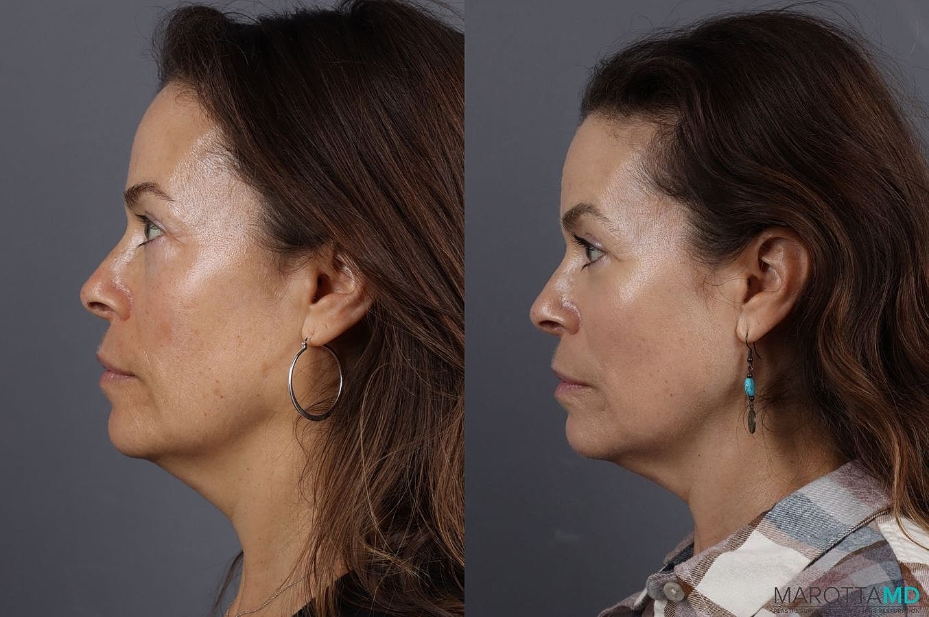 Lower Blepharoplasty Before & After