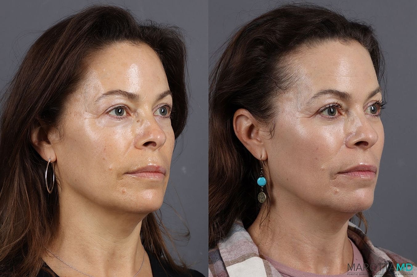 Lower Blepharoplasty Before & After