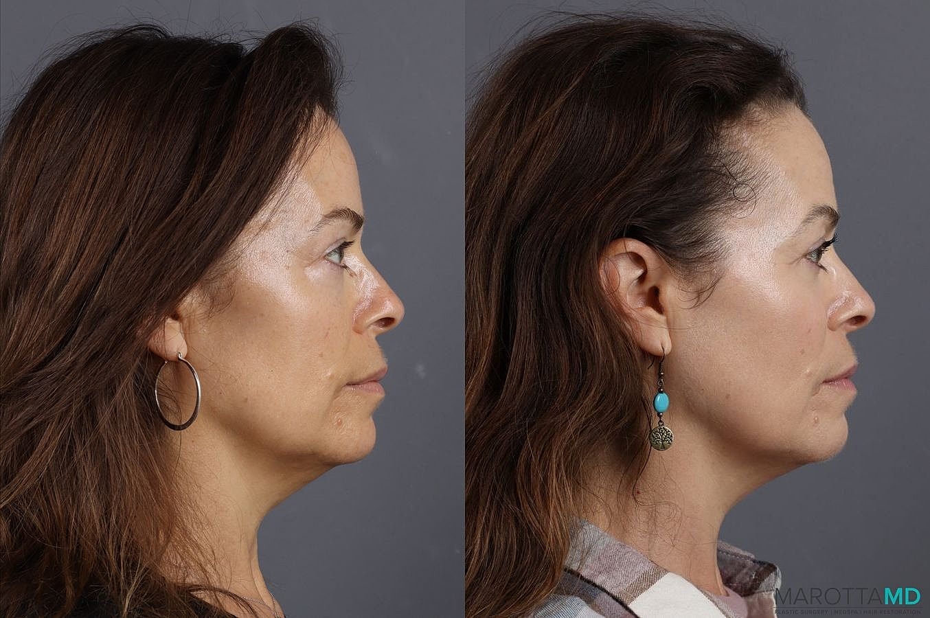Lower Blepharoplasty Before & After
