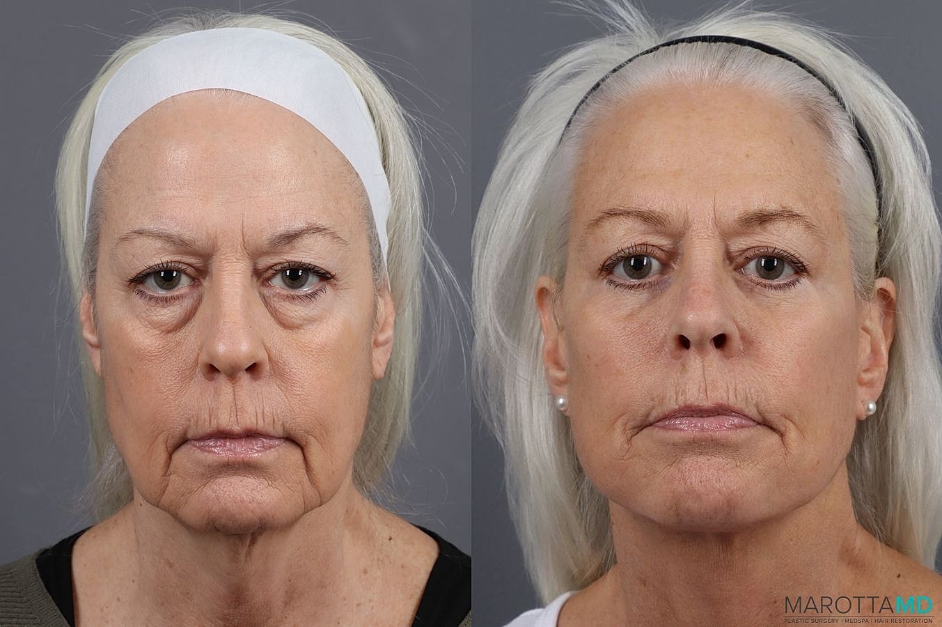 Lower Blepharoplasty Before & After