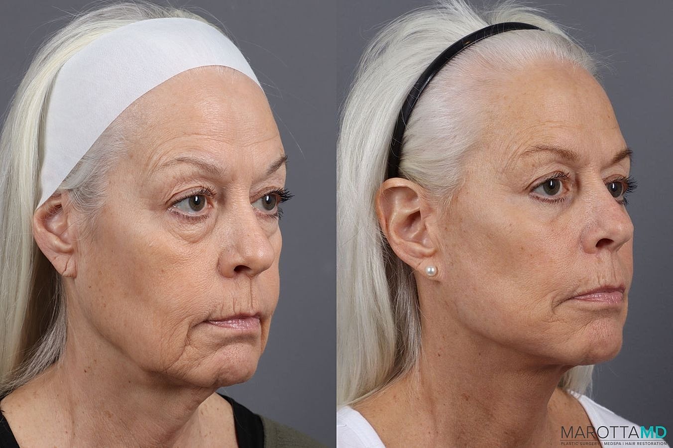 Lower Blepharoplasty Before & After